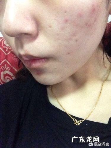 白白的那种 对于脸上不断长痘痘怎么缓解症状