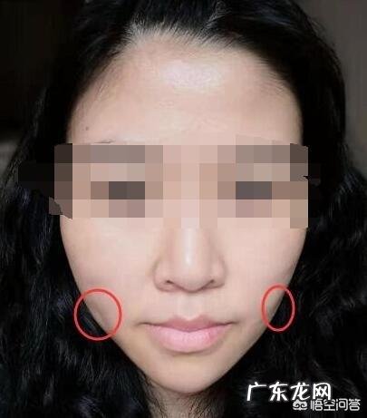 线雕术后有一道凹陷,应该怎么解决