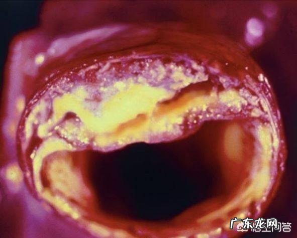 冠心病,饭该怎么吃?