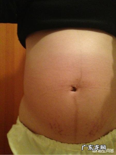 怀孕三个半月，肚脐以下的妊娠线居中，肚脐以上的妊娠线偏左，是怎么回事？