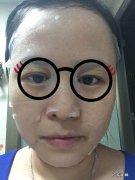 敷面膜过敏的症状有什么