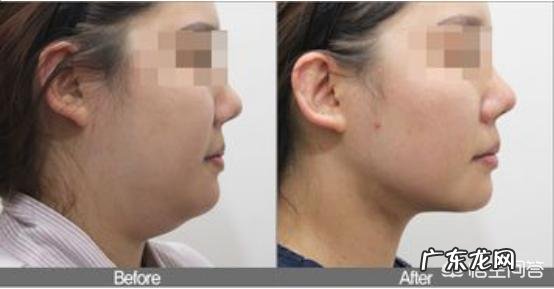 怎样减掉下巴上的赘肉?