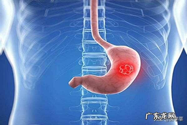 体检报告说我幽门螺旋杆菌有点高,但是我没什么感觉,很严重吗