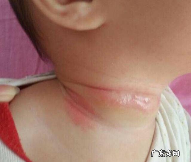 我家宝宝老是容易淹脖子,抹点松达山茶油有效吗