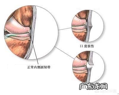 造成膝关节内侧副韧带扭伤的原因是什么其主要症状有哪些