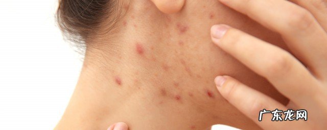 脖子上长痘痘是什么原因