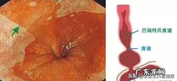 巴雷特食管异型增生率高吗