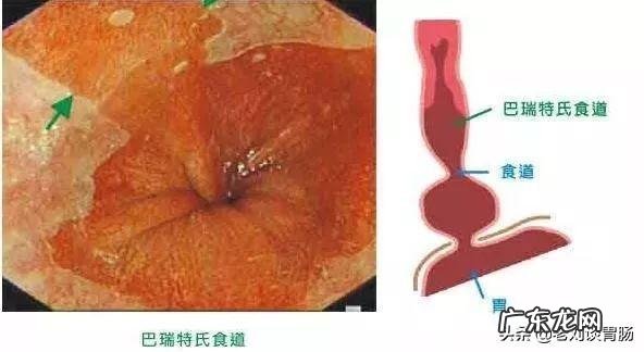巴雷特食管异型增生率高吗
