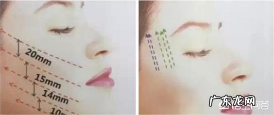 大V线雕做完之后多久才能再做下