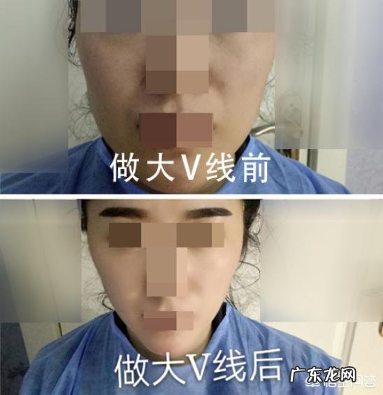 大V线雕做完之后多久才能再做下