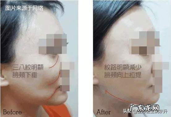 大V线雕做完之后多久才能再做下