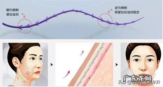 大V线雕做完之后多久才能再做下