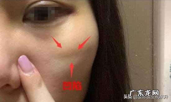 大V线雕做完之后多久才能再做下