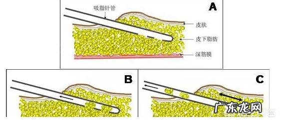 局部肥胖是否可以通过运动和抽脂结合来解决