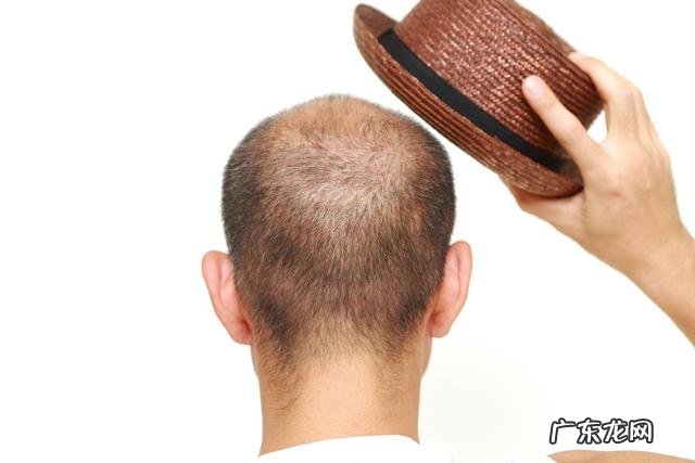 脱发应该喝什么中药调理