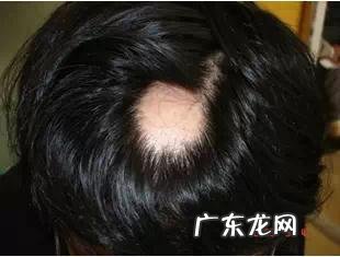 更年期女性脱发中医怎么治疗