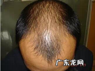 更年期女性脱发中医怎么治疗