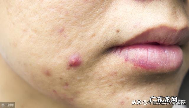 痤疮的炎症和非炎症阶段如何应对