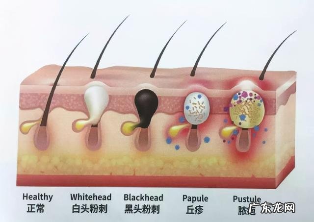 痤疮的中医辨证治疗医案