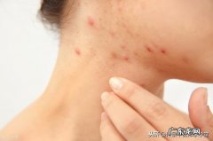 脸上的痤疮用什么中药收敛