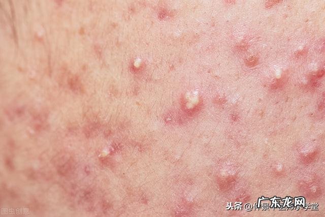 脸上的痤疮用什么中药收敛