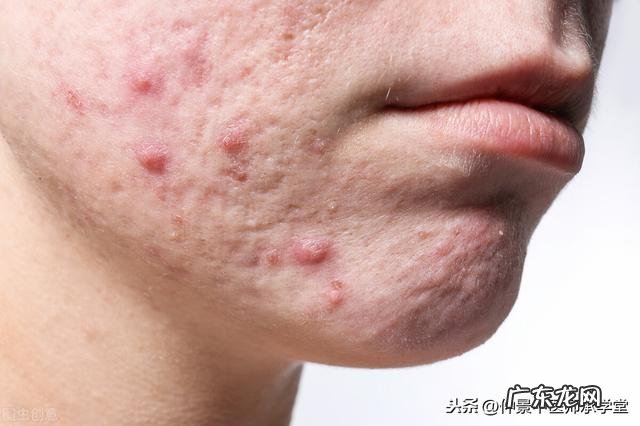 脸上的痤疮用什么中药收敛