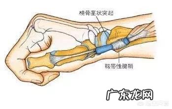 得了腱鞘炎,如何缓解疼痛?