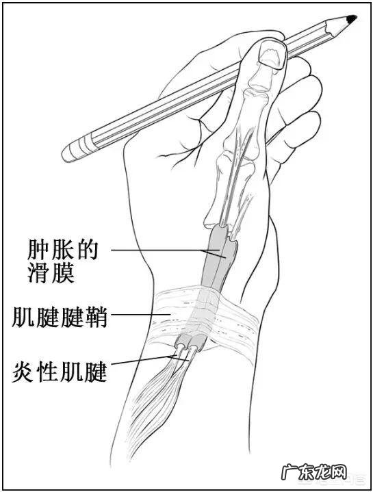 得了腱鞘炎,如何缓解疼痛?