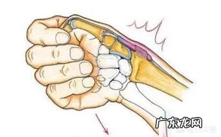 得了腱鞘炎,如何缓解疼痛?