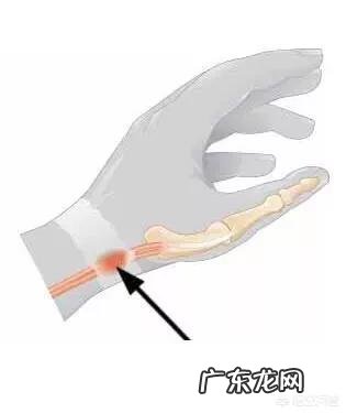 得了腱鞘炎,如何缓解疼痛?