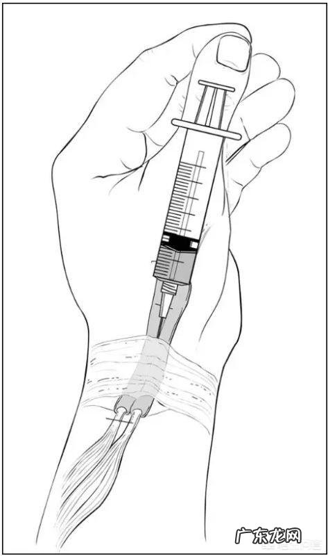 得了腱鞘炎,如何缓解疼痛?