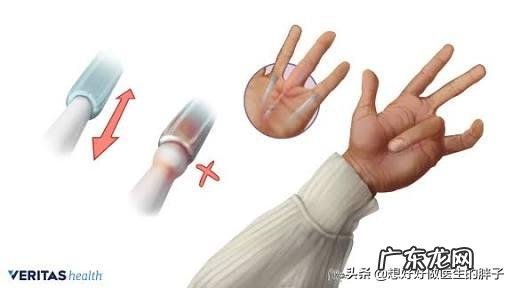 得了腱鞘炎,如何缓解疼痛?