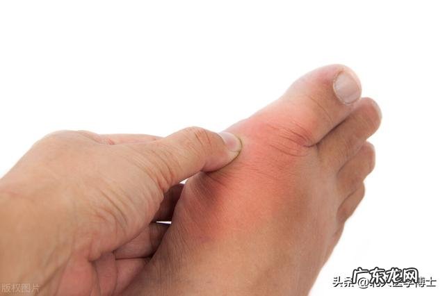 痛风内服外敷秘方