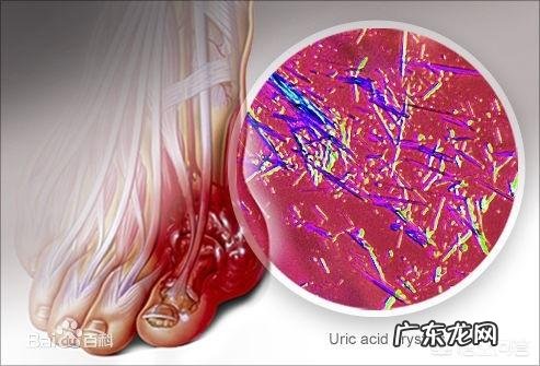 高尿酸患者可以使用哪些降尿酸的药物有什么副作用