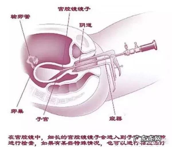 做宫腔镜手术后有什么注意事项