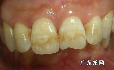 减脂期间为什么牙齿变黄了很多