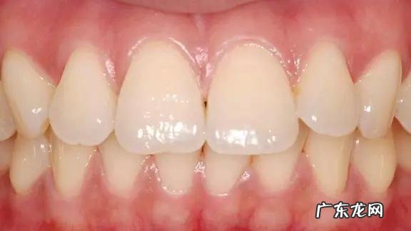 减脂期间为什么牙齿变黄了很多