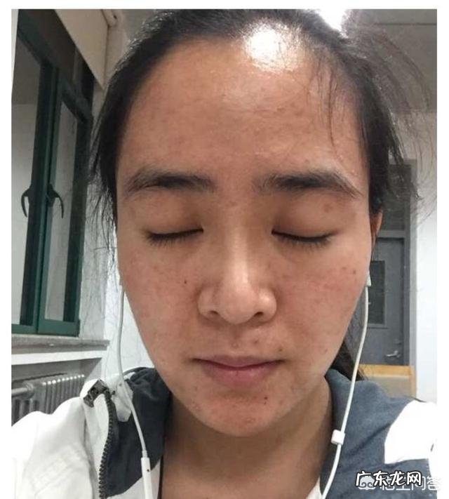 未成年如何祛斑、祛痘?