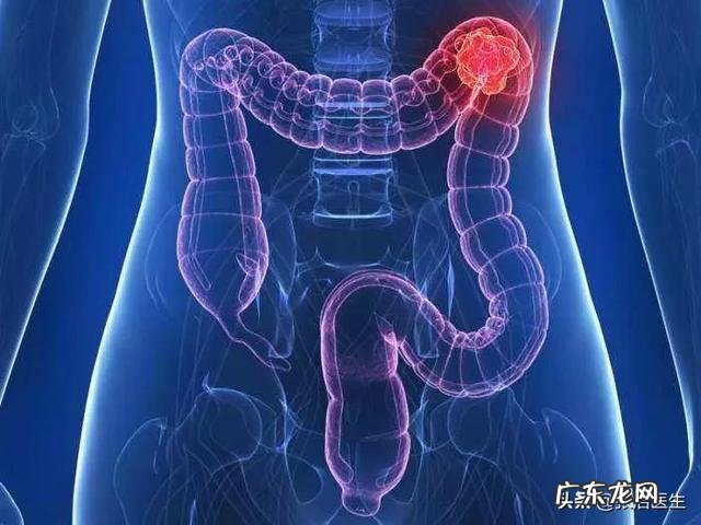 肠癌有什么前兆症状?