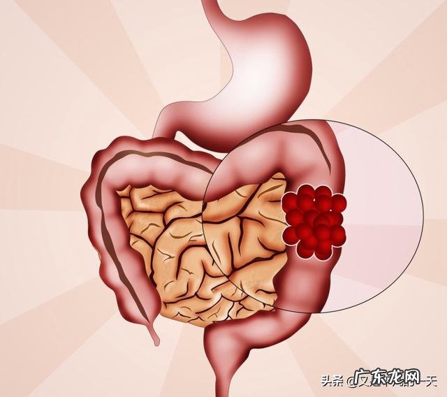 肠癌有什么前兆症状?