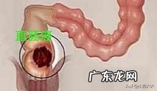 肠癌有什么前兆症状？