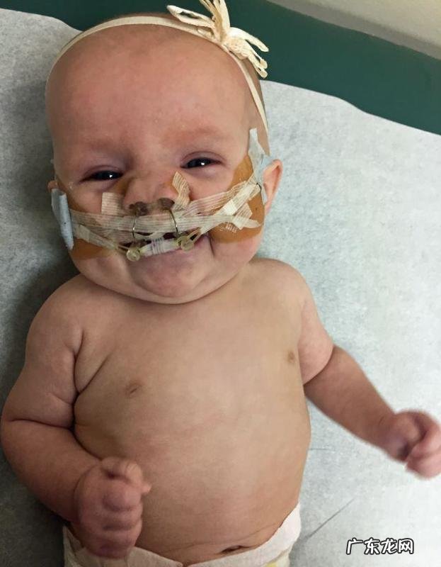 检查出孩子唇裂怎么办?