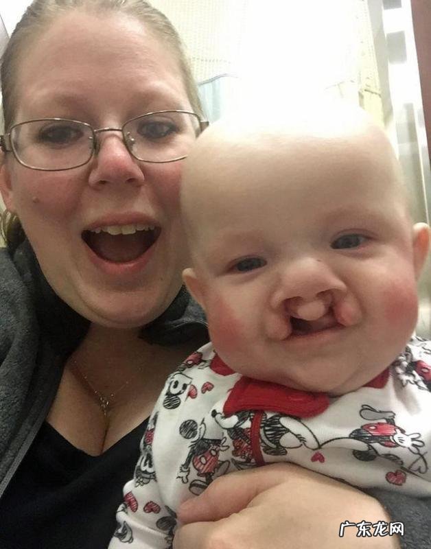 检查出孩子唇裂怎么办?