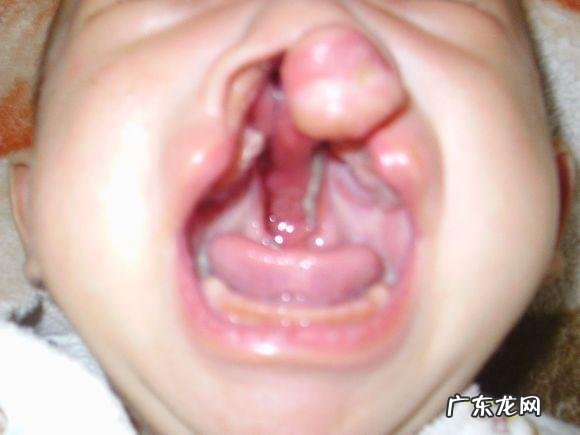 检查出孩子唇裂怎么办?