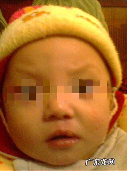 检查出孩子唇裂怎么办?