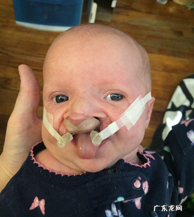 检查出孩子唇裂怎么办?