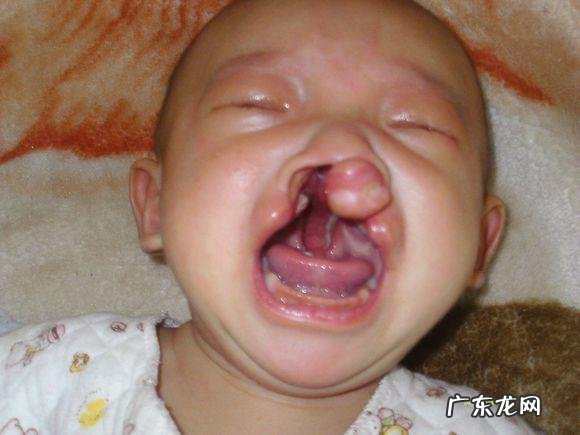 检查出孩子唇裂怎么办?