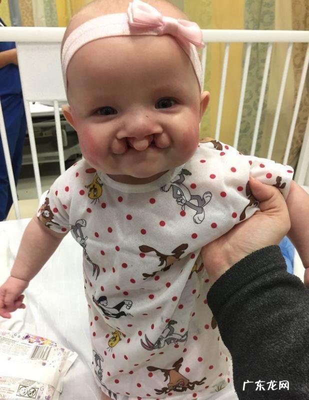 检查出孩子唇裂怎么办?