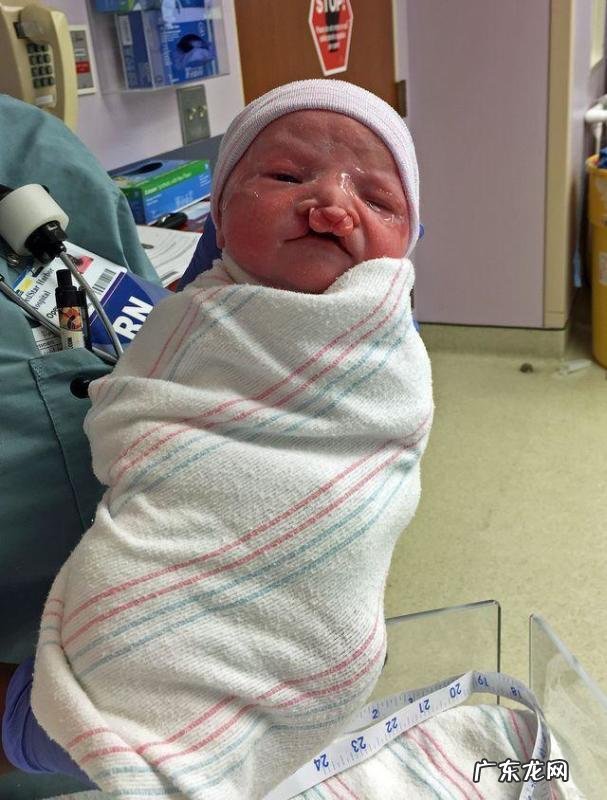 检查出孩子唇裂怎么办?