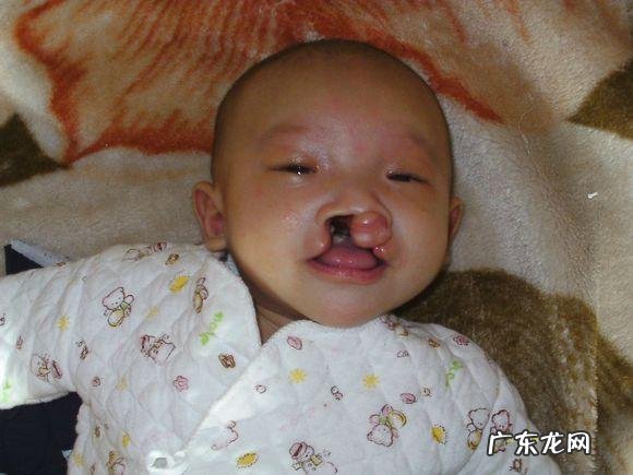 检查出孩子唇裂怎么办?